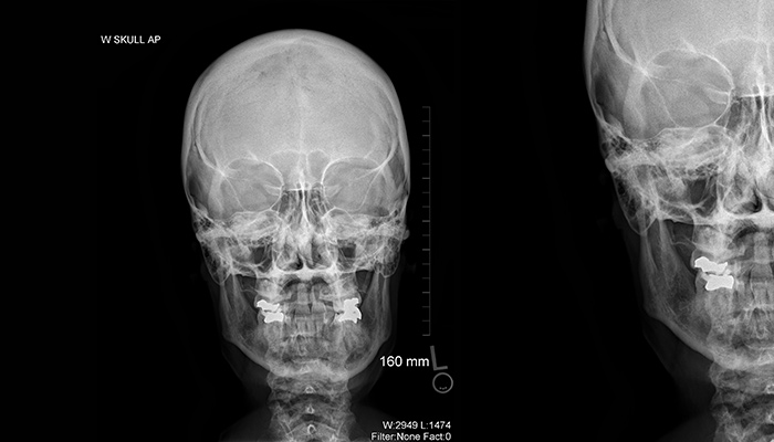 Skull X-ray