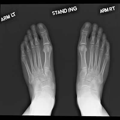 Distal Lower Extremity