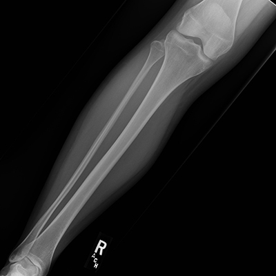 Proximal Lower Extremity