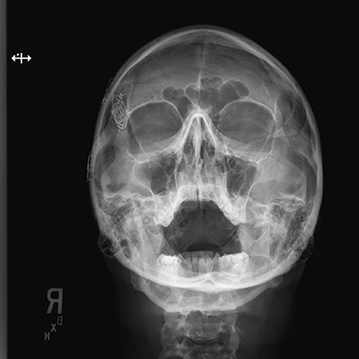 Sinuses and Mandible