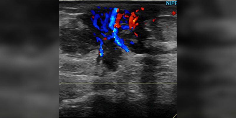 Breast Imaging Essentials: Module 9 - Breast Ultrasound